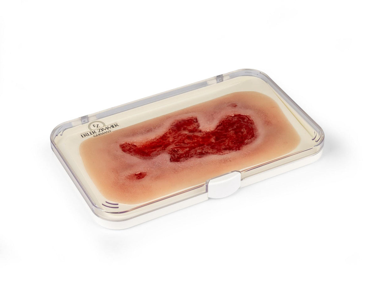Erler-Zimmer Wundmoulage Ulcus Cruris Arteriosum, groß, Epithelisierungsphase