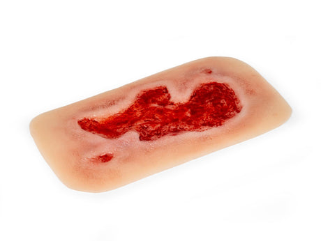Erler-Zimmer Wundmoulage Ulcus Cruris Arteriosum, groß, Epithelisierungsphase
