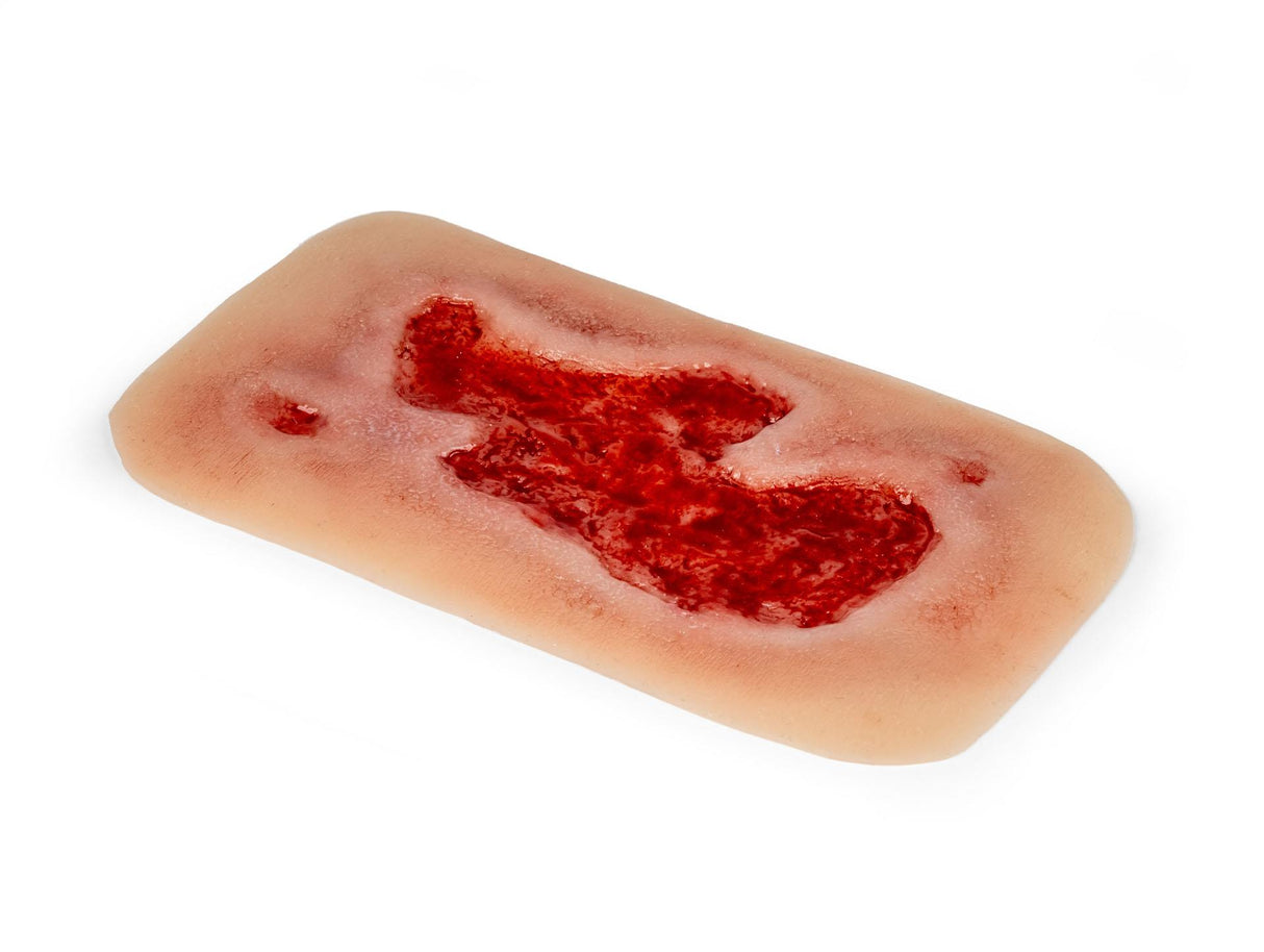 Erler-Zimmer Wundmoulage Ulcus Cruris Arteriosum, groß, Epithelisierungsphase