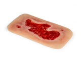 Erler-Zimmer Wundmoulage Ulcus Cruris Arteriosum, groß, Epithelisierungsphase