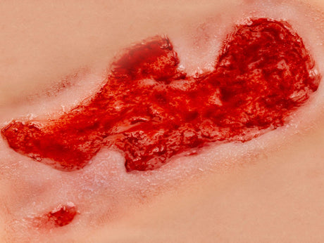 Erler-Zimmer Wundmoulage Ulcus Cruris Arteriosum, groß, Epithelisierungsphase
