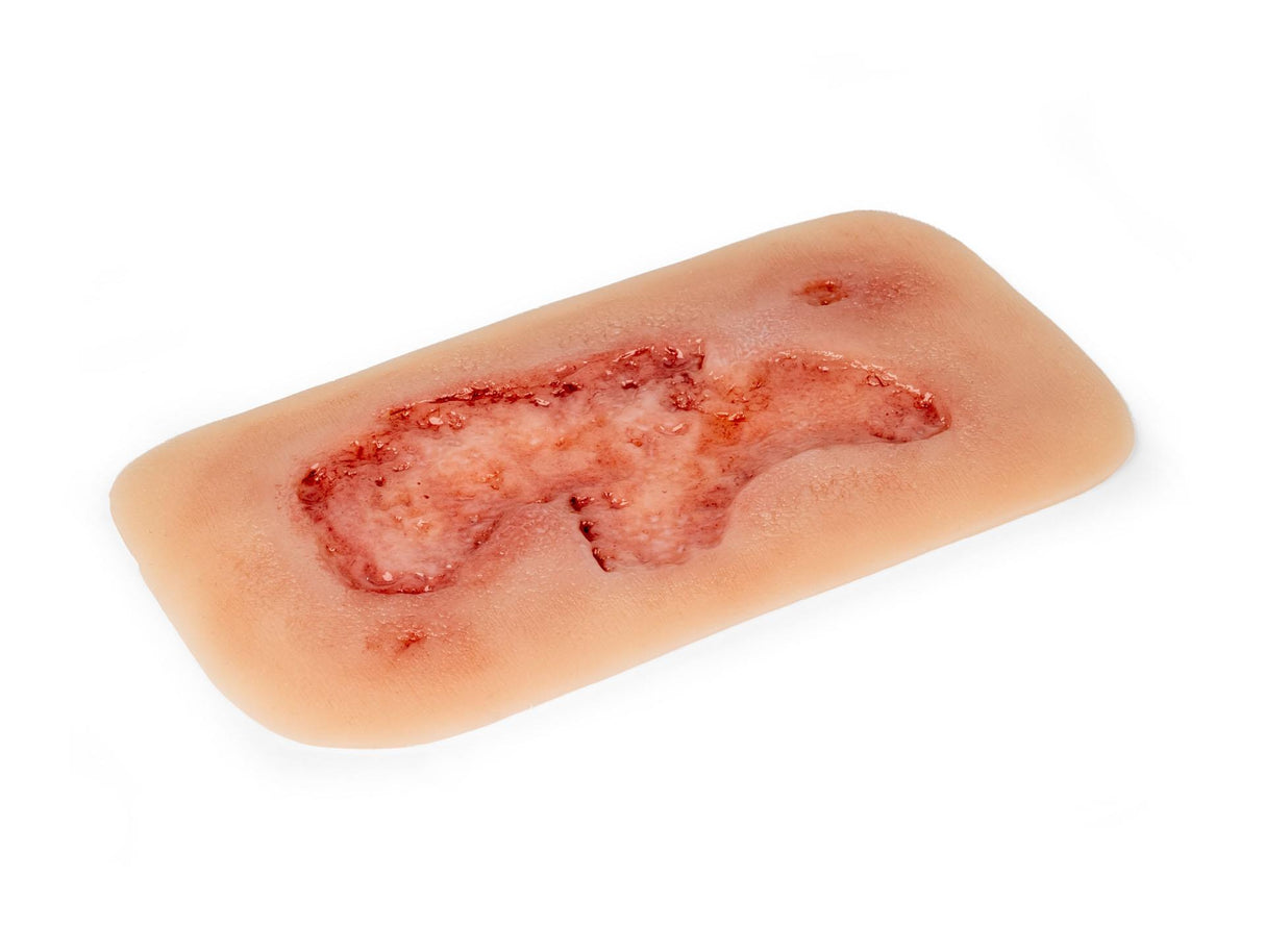 Erler-Zimmer Wundmoulage Ulcus Cruris Arteriosum, groß, Epithelisierungsphase