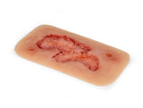Erler-Zimmer Wundmoulage Ulcus Cruris Arteriosum, groß, Epithelisierungsphase