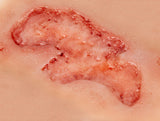 Erler-Zimmer Wundmoulage Ulcus Cruris Arteriosum, groß, Epithelisierungsphase