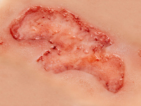 Erler-Zimmer Wundmoulage Ulcus Cruris Arteriosum, groß, Epithelisierungsphase