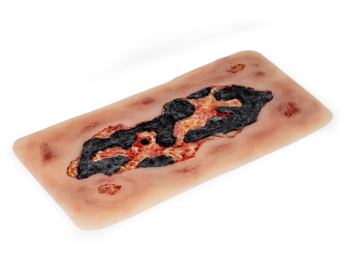 Erler-Zimmer Wundmoulage Ulcus Cruris Arteriosum, groß, Epithelisierungsphase