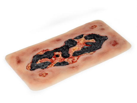 Erler-Zimmer Wundmoulage Ulcus Cruris Arteriosum, groß, Epithelisierungsphase