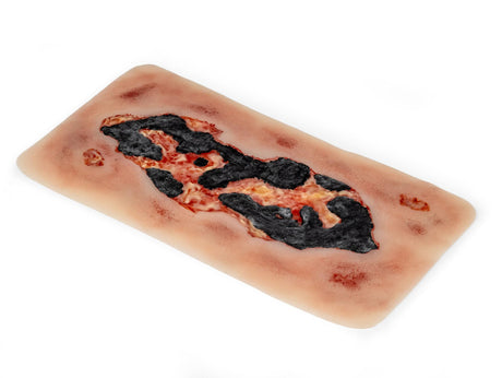 Erler-Zimmer Wundmoulage Ulcus Cruris Arteriosum, groß, Epithelisierungsphase