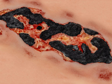 Erler-Zimmer Wundmoulage Ulcus Cruris Arteriosum, groß, Epithelisierungsphase