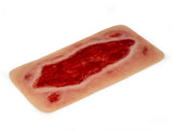 Erler-Zimmer Wundmoulage Ulcus Cruris Arteriosum, groß, Epithelisierungsphase