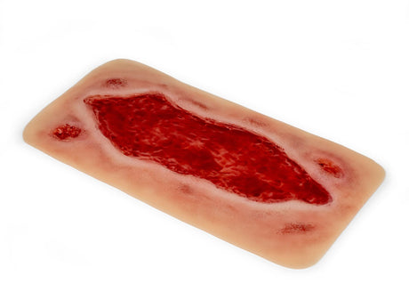 Erler-Zimmer Wundmoulage Ulcus Cruris Arteriosum, groß, Epithelisierungsphase