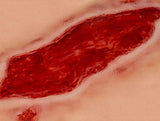 Erler-Zimmer Wundmoulage Ulcus Cruris Arteriosum, groß, Epithelisierungsphase