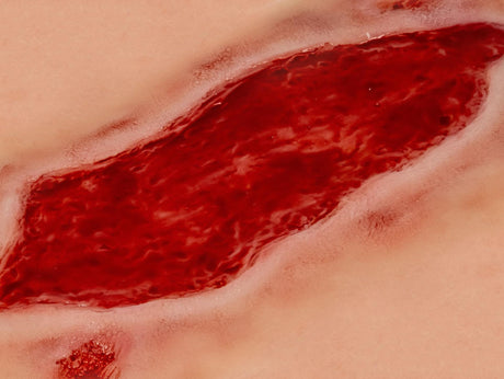 Erler-Zimmer Wundmoulage Ulcus Cruris Arteriosum, groß, Epithelisierungsphase