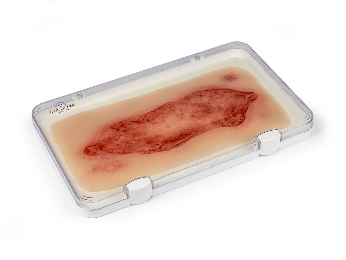 Erler-Zimmer Wundmoulage Ulcus Cruris Arteriosum, groß, Epithelisierungsphase