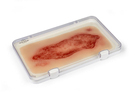 Erler-Zimmer Wundmoulage Ulcus Cruris Arteriosum, groß, Epithelisierungsphase