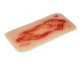 Erler-Zimmer Wundmoulage Ulcus Cruris Arteriosum, groß, Epithelisierungsphase