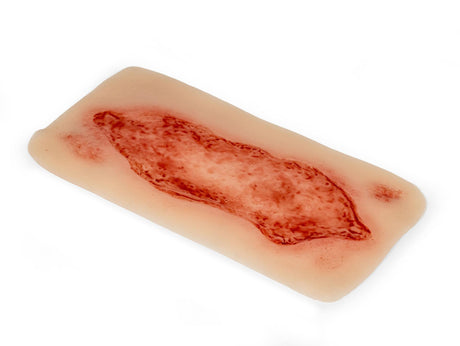 Erler-Zimmer Wundmoulage Ulcus Cruris Arteriosum, groß, Epithelisierungsphase