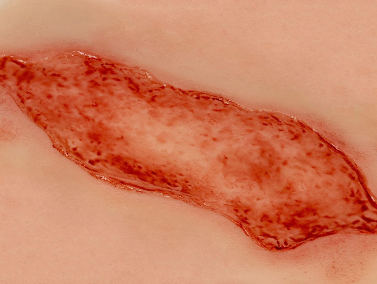 Erler-Zimmer Wundmoulage Ulcus Cruris Arteriosum, groß, Epithelisierungsphase