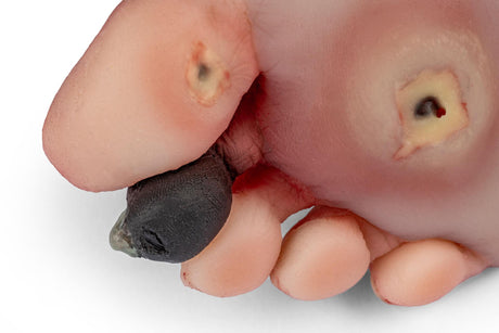 Erler-Zimmer Wundenfuß mit diabetischem Fußsyndrom