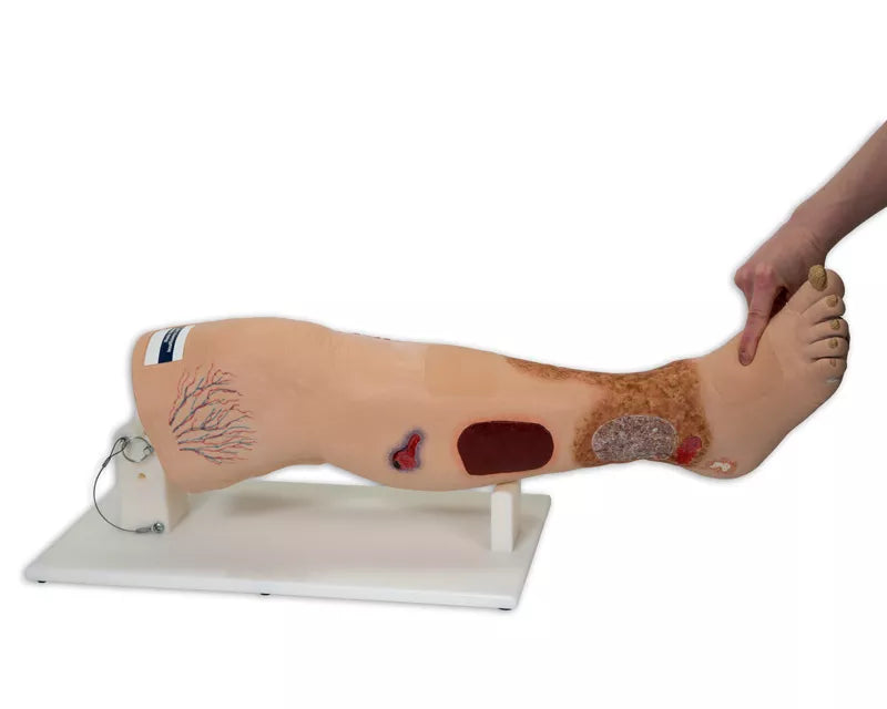 Erler-Zimmer Vinnie, Bein mit venöser Insuffizienz