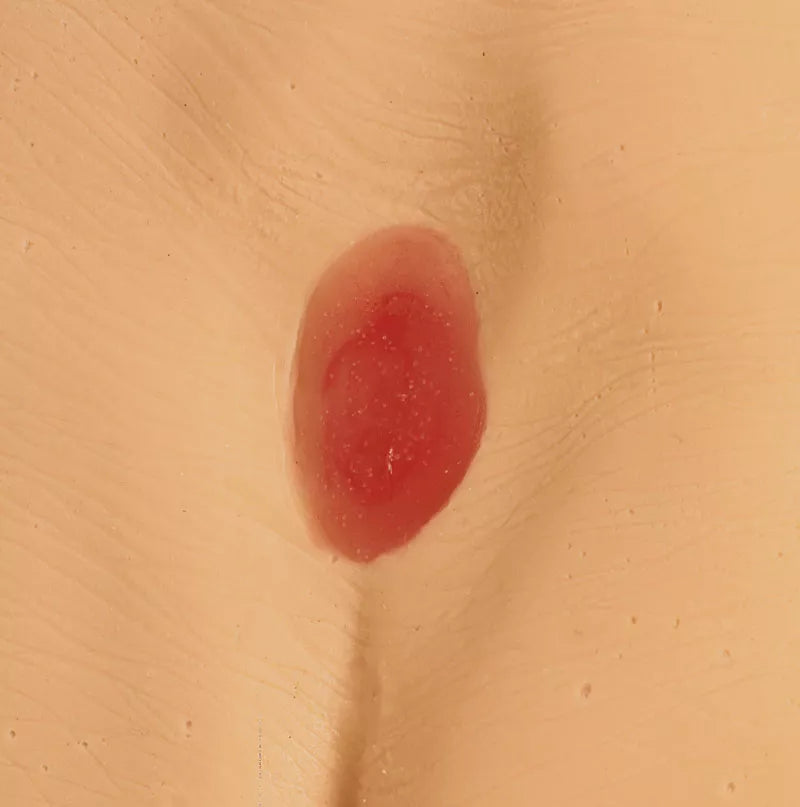 Erler-Zimmer Druckgeschwür / Dekubitus Modelle
