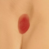 Erler-Zimmer Druckgeschwür / Dekubitus Modelle