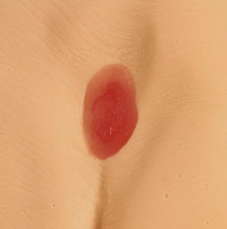 Erler-Zimmer Druckgeschwür / Dekubitus Modelle