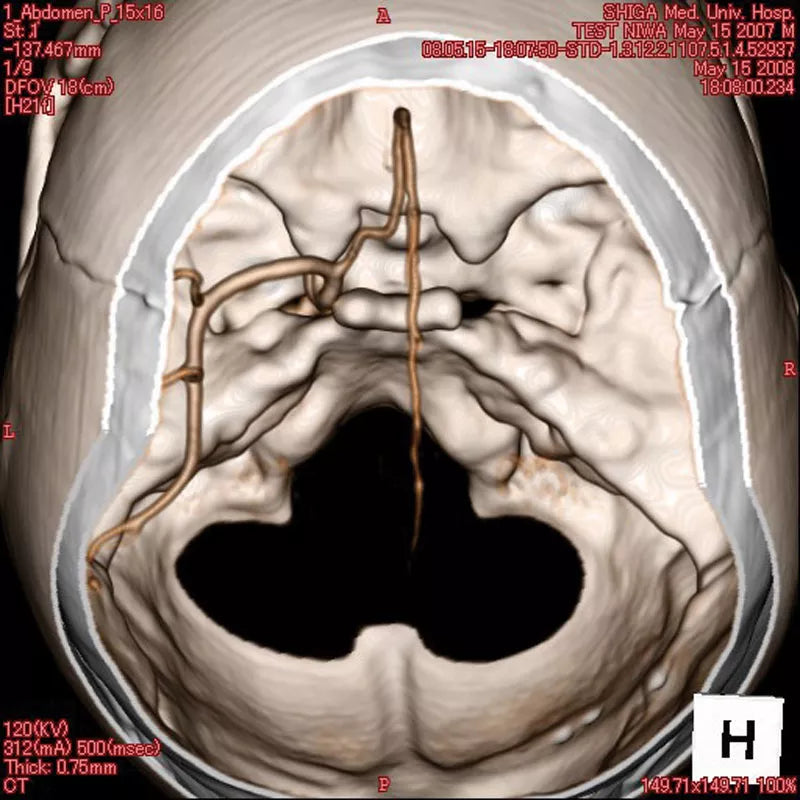 Erler-Zimmer Angiographie Kopfmodell