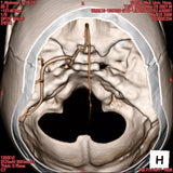 Erler-Zimmer Angiographie Kopfmodell