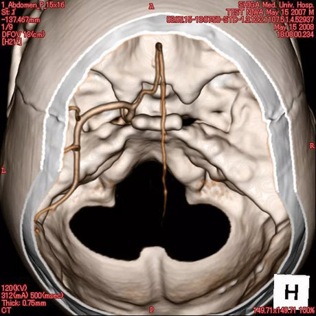 Erler-Zimmer Angiographie Kopfmodell