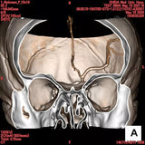 Erler-Zimmer Angiographie Kopfmodell