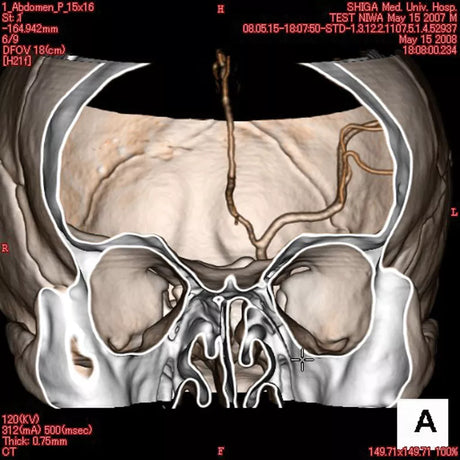 Erler-Zimmer Angiographie Kopfmodell