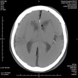 Erler-Zimmer Angiographie Kopfmodell