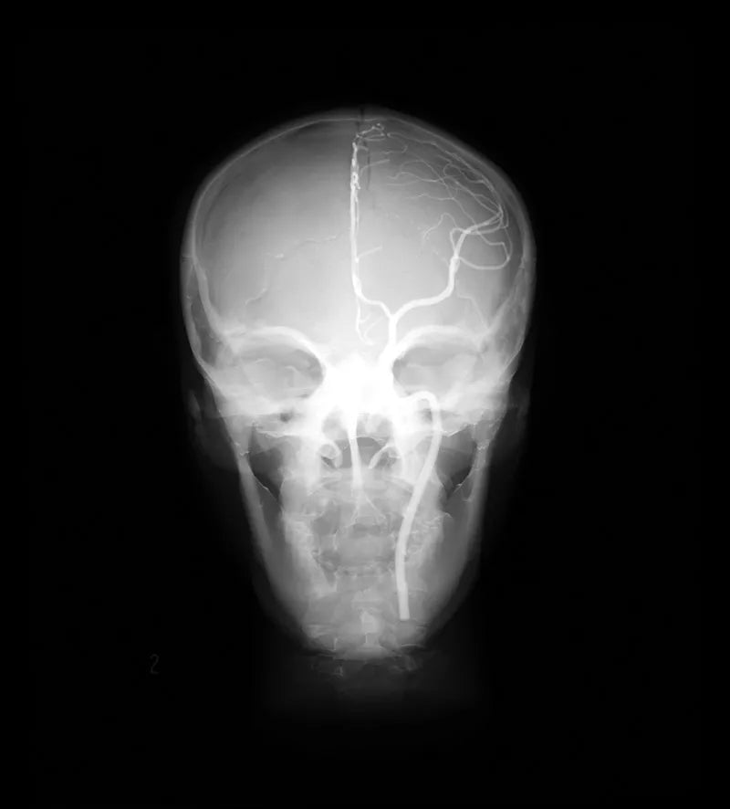Erler-Zimmer Angiographie Kopfmodell