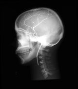 Erler-Zimmer Angiographie Kopfmodell