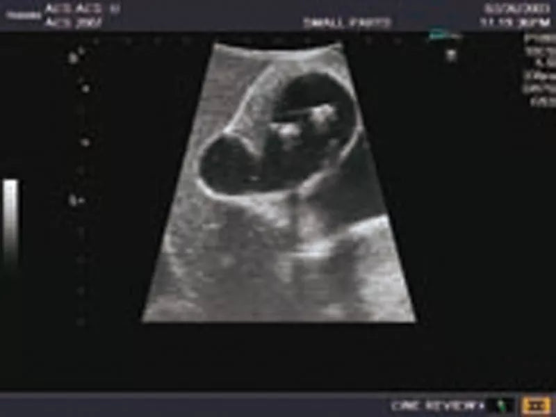 Erler-Zimmer Ultraschall-Modell für Sonografie