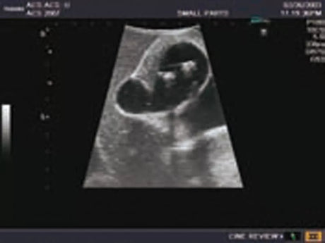 Erler-Zimmer Ultraschall-Modell für Sonografie