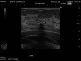Erler-Zimmer Ultraschalluntersuchungsphantom-Brust