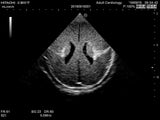 Erler-Zimmer Neonatales Ultraschall-Übungsphantom Kopf