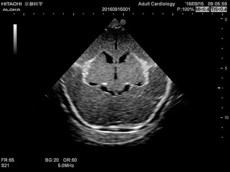 Erler-Zimmer Neonatales Ultraschall-Übungsphantom Kopf
