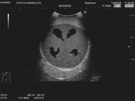 Erler-Zimmer Neonatales Ultraschall-Übungsphantom Kopf mit Hydrocephalus