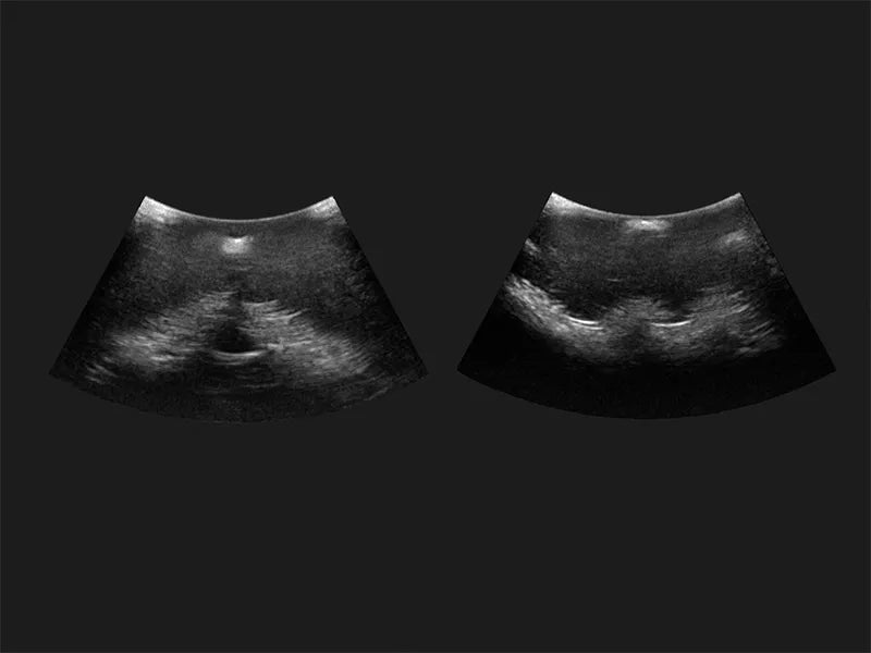 Erler-Zimmer Epidural- und Spinalinjektionssimulator Genesis