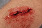 Erler-Zimmer EZ Wounds Wundensimulationsset „Professional“