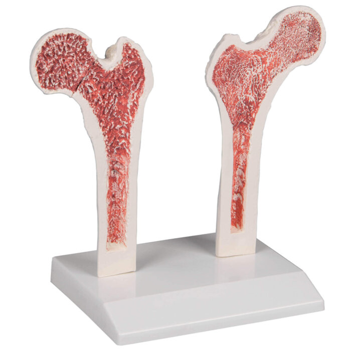 Erler-Zimmer Oberschenkel Modell Osteoporose